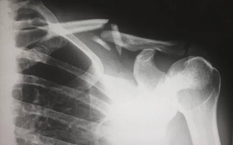 Ile trwa rehabilitacja po złamaniu obojczyka? Poznaj kluczowe informacje