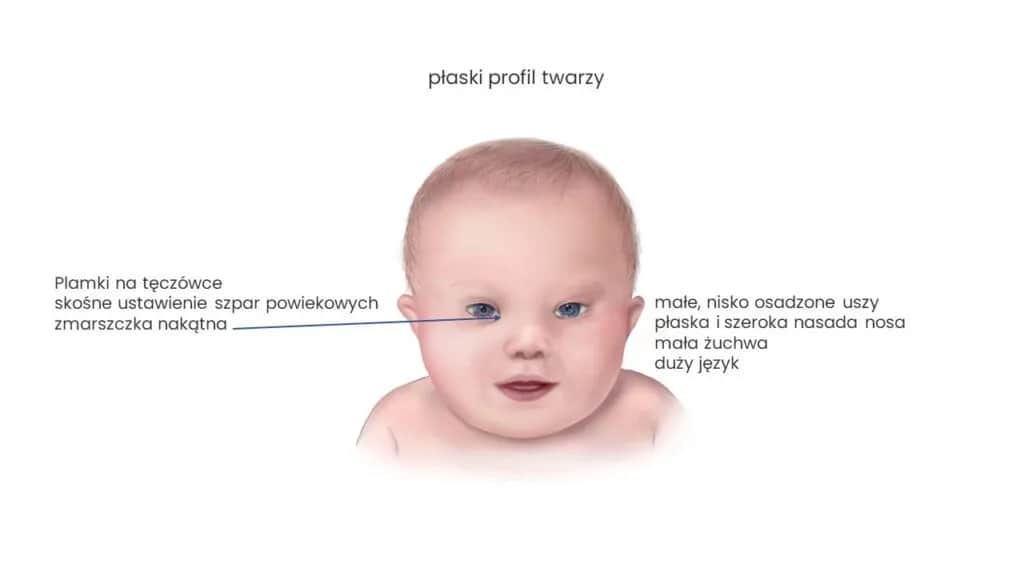 Kiedy wiadomo że dziecko ma zespół Downa? Objawy i diagnoza