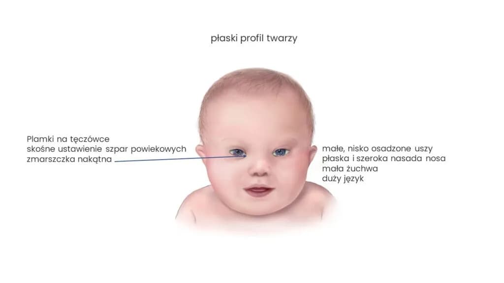 Kiedy wiadomo że dziecko ma zespół Downa? Objawy i diagnoza