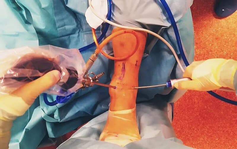 Ile trwa rehabilitacja po artroskopii stawu skokowego i co wpływa na czas?