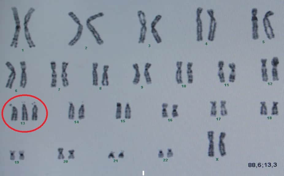 Ile chromosomów ma człowiek z autyzmem? Zaskakujące fakty genetyczne