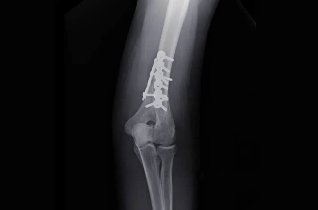 Kiedy zacząć rehabilitację po złamaniu kości ramiennej, aby uniknąć bólu?