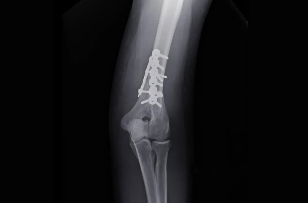 Kiedy zacząć rehabilitację po złamaniu kości ramiennej, aby uniknąć bólu?