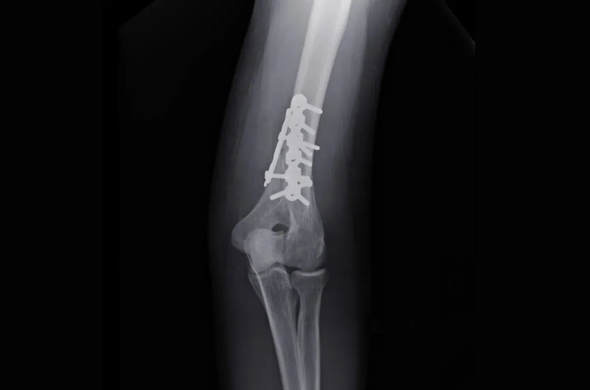 Kiedy zacząć rehabilitację po złamaniu kości ramiennej, aby uniknąć bólu?